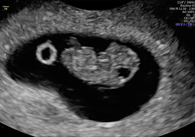 Scan of an early baby between 7-10 weeks