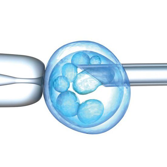 What is Preimplantation Genetic Screening in IVF?