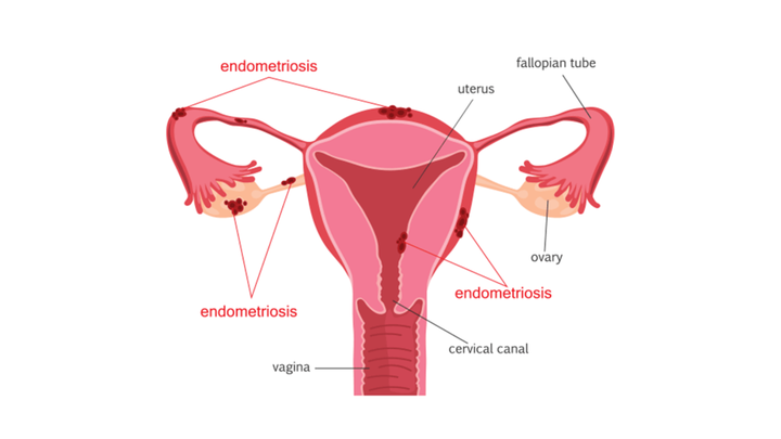 endometriosis-womb-diagram