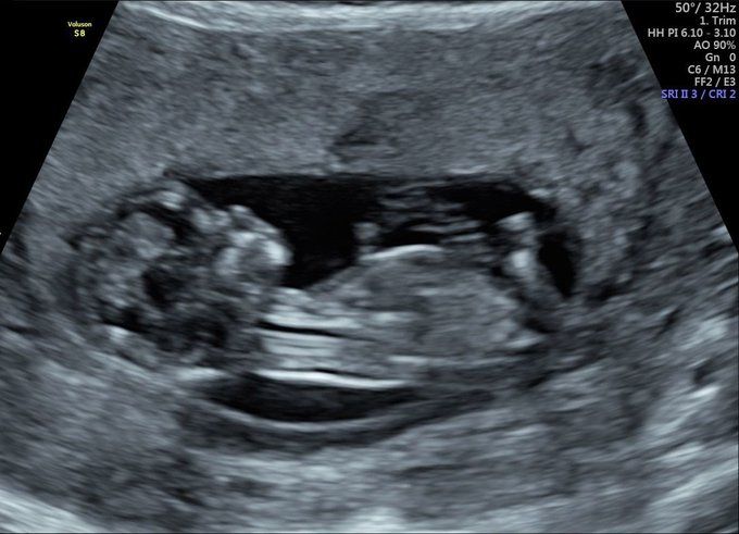 Scan of a baby at 12 weeks